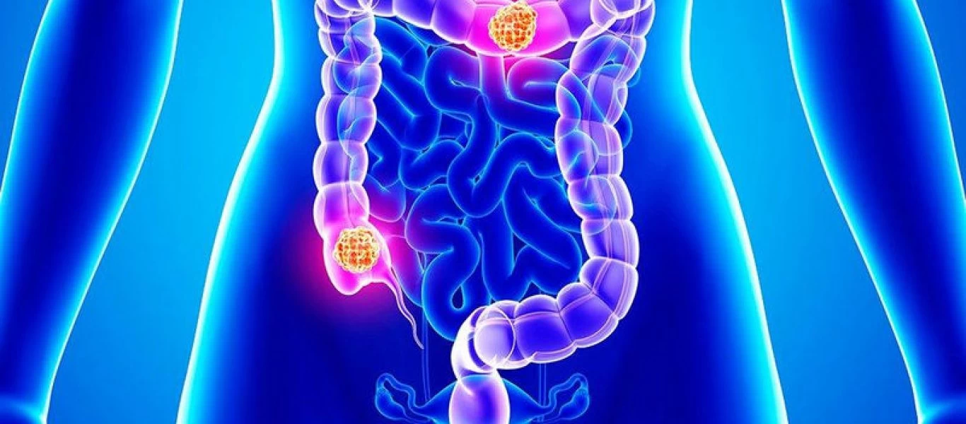 Καρκίνος του παχέος εντέρου: Πρόληψη μέσω της διατροφής - Oι τέσσερις «θαυματουργές» τροφές